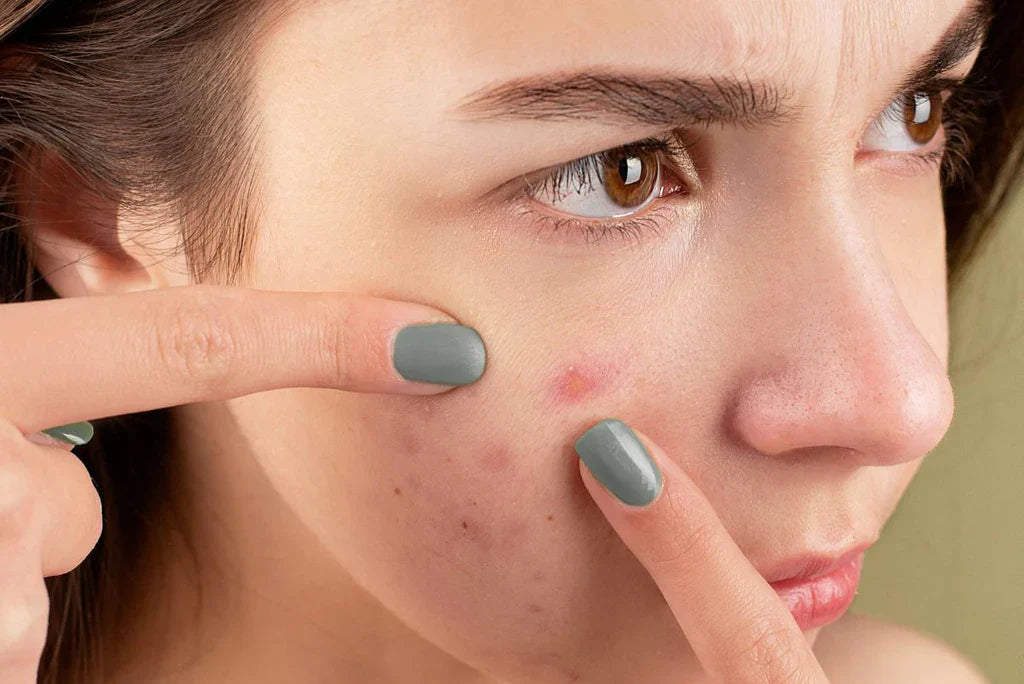 Acne & Blemish Control Products | Best Acne Treatments