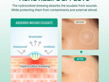 SOME BY MI 30 Days Miracle Clear Spot Patch