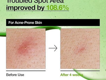 ANUA AZELAIC HYALURON Soothing Serum – 30mL