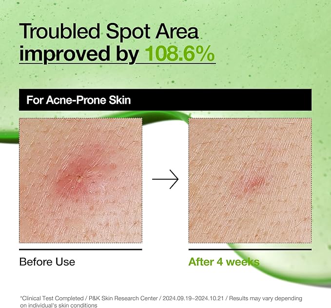 ANUA AZELAIC HYALURON Soothing Serum – 30mL