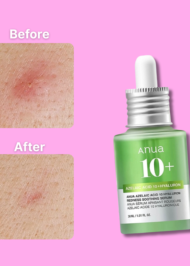 ANUA AZELAIC HYALURON Soothing Serum – 30mL