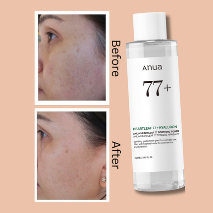 ANUA Heartleaf 77% Soothing Toner I pH 5.5 Trouble Care