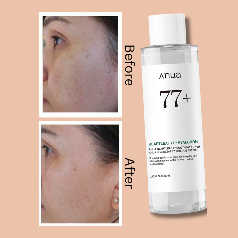 ANUA Heartleaf 77% Soothing Toner I pH 5.5 Trouble Care
